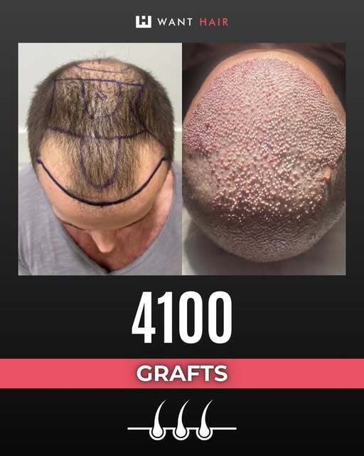 Best Hair Loss Treatment UK: Advanced Options for Hair Recovery