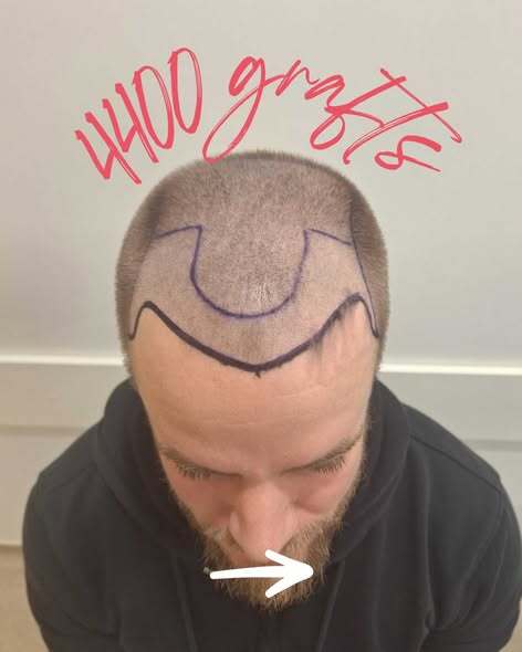 Expert Hair Loss Treatment London from Certified Specialists