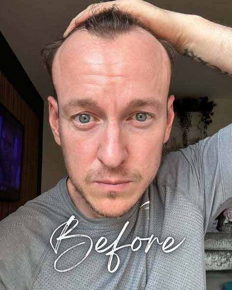 Professional Hair Loss Clinic London for Long-Term Hair Health