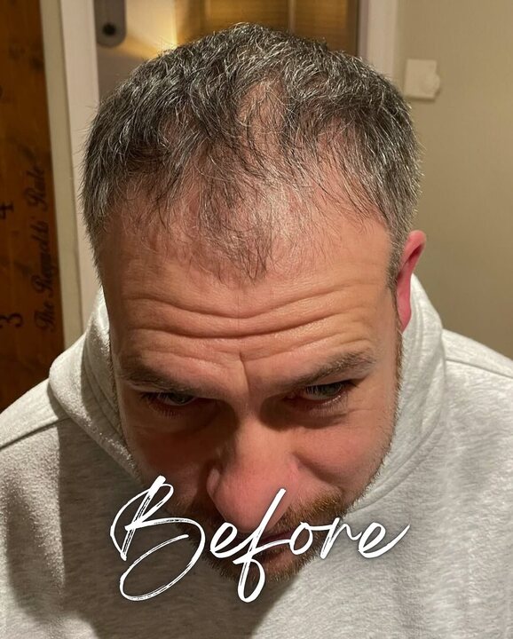 Minimally Invasive DHI Hair Transplant for Natural Density