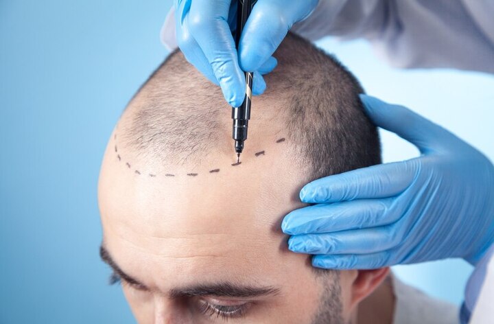 UK's Best Hair Loss Treatments According to Specialists