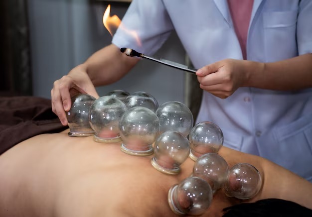 Cupping Therapy: Benefits for Pain Relief and Recovery