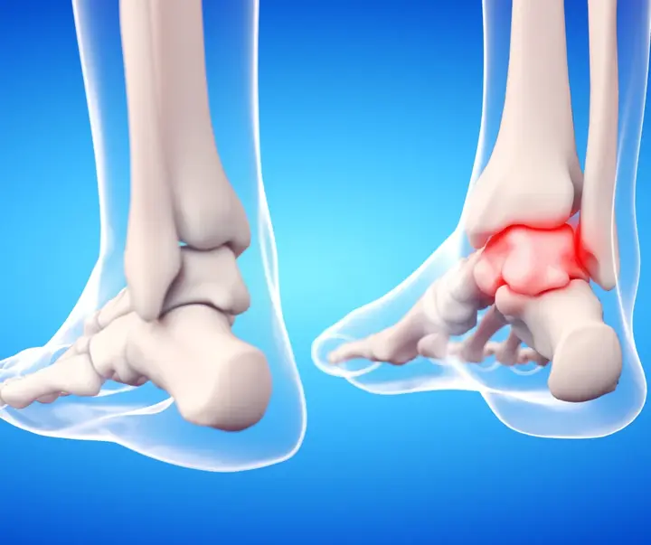 Ankle Bone Fracture Treatment What Recovery Actually Feels Like