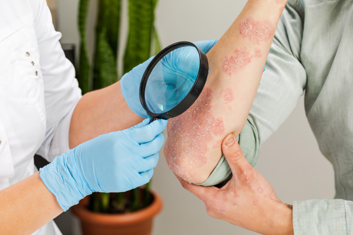 Eczema Treatment in Delhi | Iksana Wellness Clinic