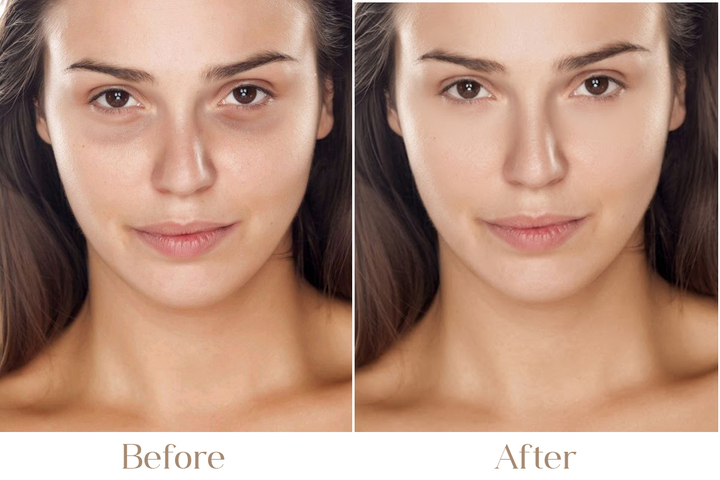 Under Eye Dark Circles, Hollowness &amp; Bags - Best Dermatologist i