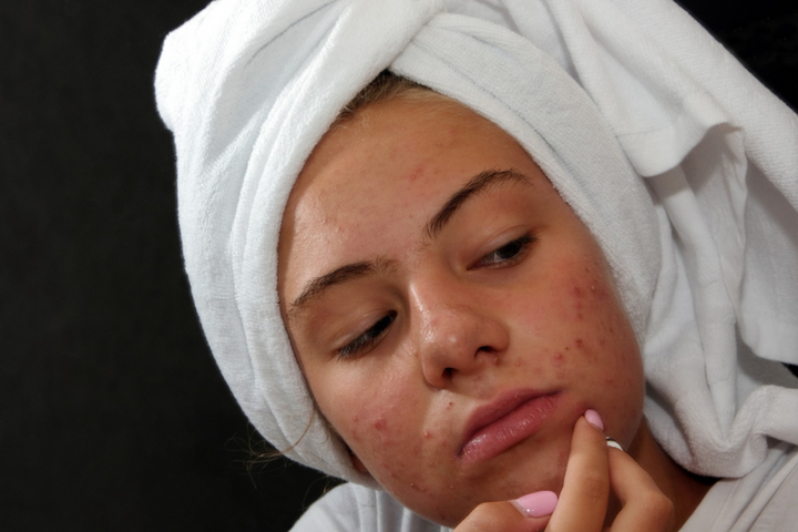 Active Acne Treatment in Delhi for Clear Healthy Skin