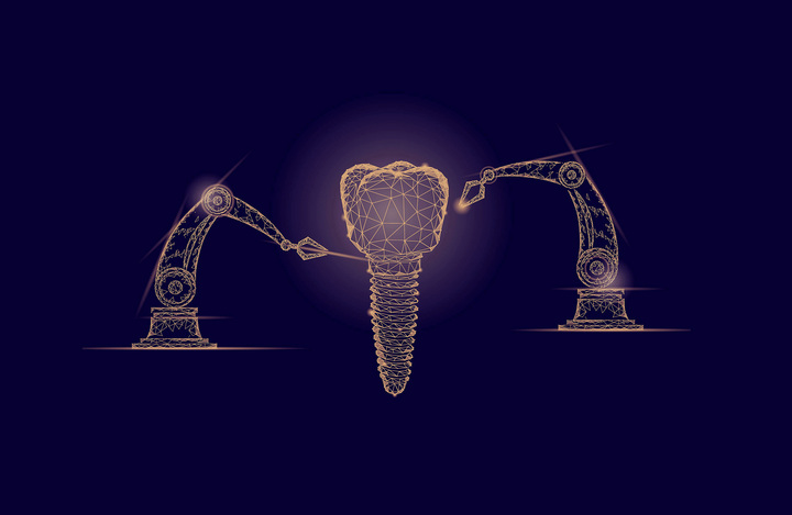 Dental Implants Sydney | Tooth Implants | Sydney Dental Implant 