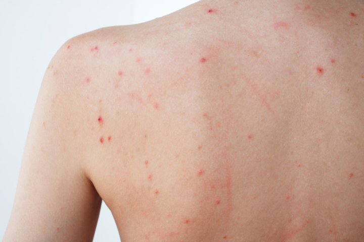 Body Acne Treatment in Delhi | Iksana Wellness