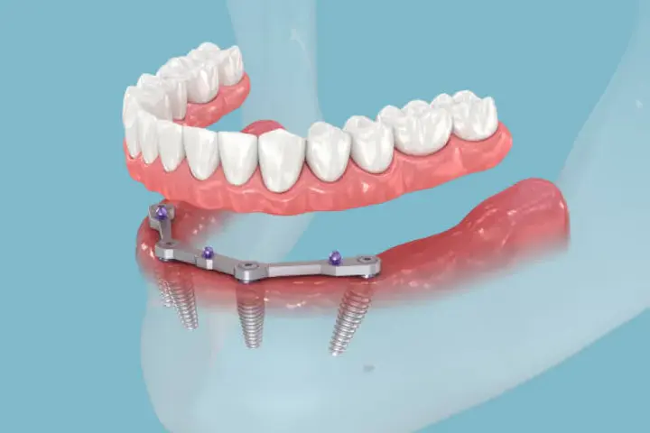 Step-by-Step Guide to Snap-In Implant Dentures - Blogosm