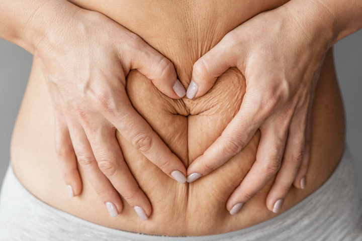 Stretch Mark Treatment in Delhi for Smooth Clear Skin