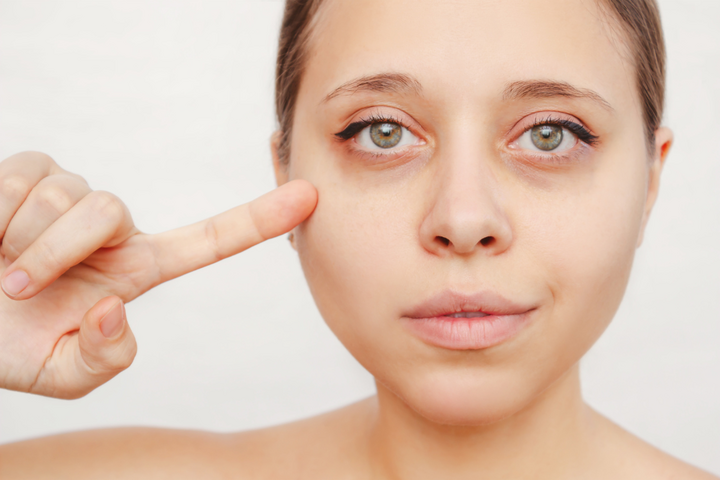 Dark Circles Treatment in Delhi | Iksana Wellness