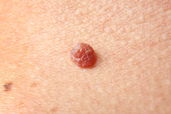 Skin Tag Removal in Delhi for Safe Smooth Skin Care