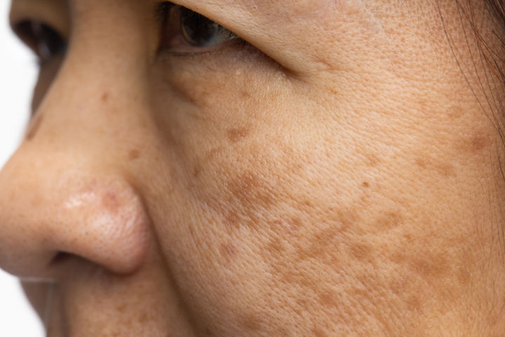 Melasma Treatment in Delhi for Clear Even Toned Skin