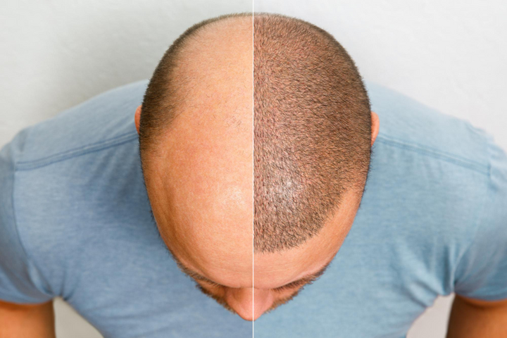 Scalp Micropigmentation in Delhi for Natural Hairline