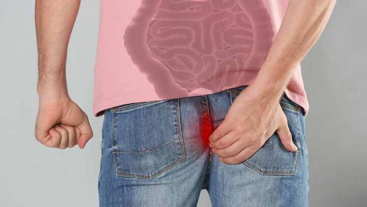 Can Fistula Heal Without Surgery? Proven Natural Remedies &amp; Perm