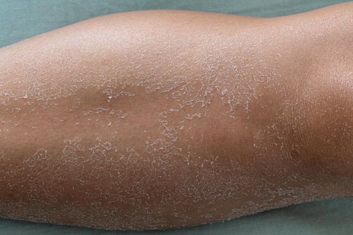 Dry Skin Treatment in Delhi | Iksana Wellness Clinic