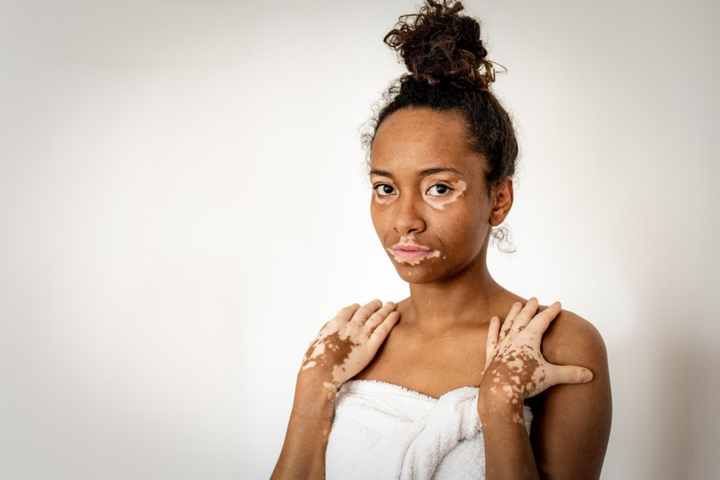 Vitiligo Treatment in Delhi | Iksana Wellness Clinic