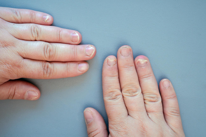 Nail Disorder Treatment in Delhi | Iksana Wellness