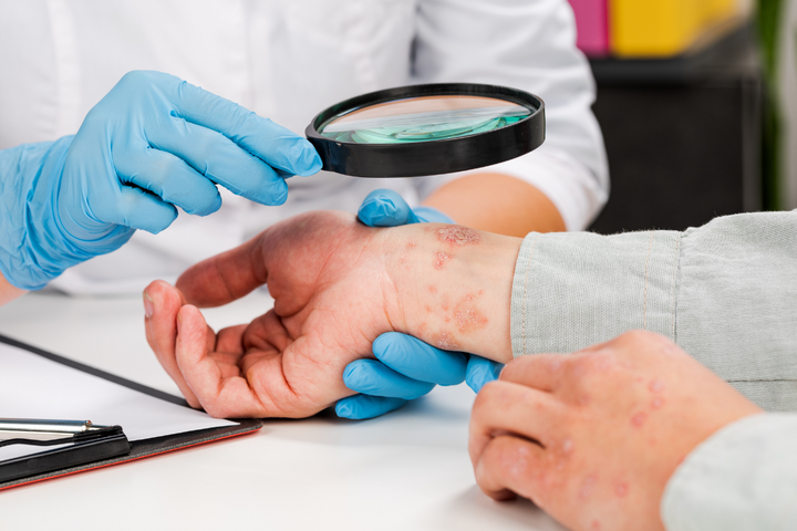 Psoriasis Treatment in Delhi | Advanced Care at Iksana