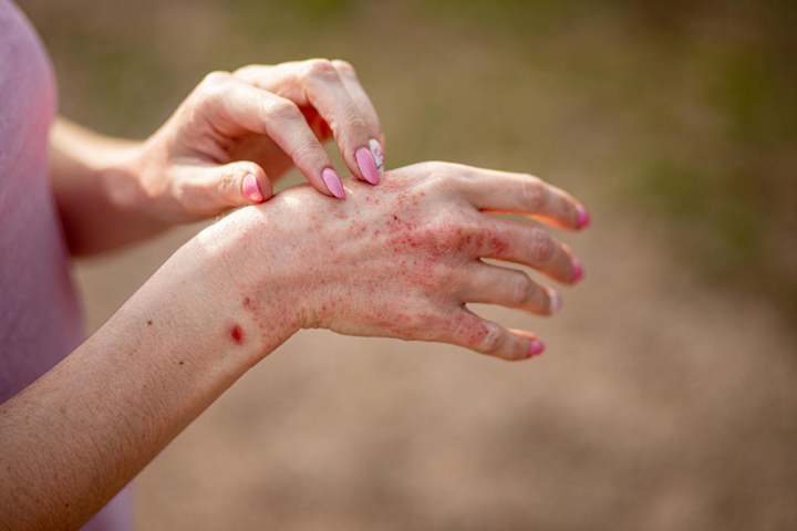 Eczema Treatment in Delhi for Healthy Itch Free Skin