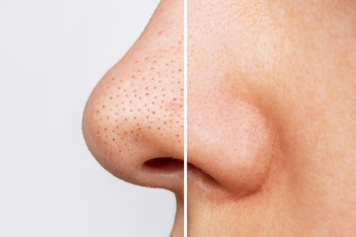 Blackheads Treatment in Delhi | Iksana Wellness Clinic