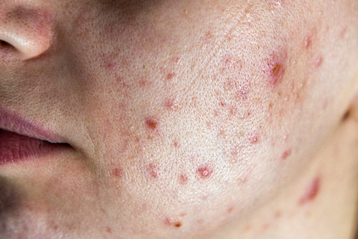 Active Acne Treatment in Delhi | Iksana Wellness